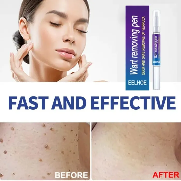 Wart Removing Pen